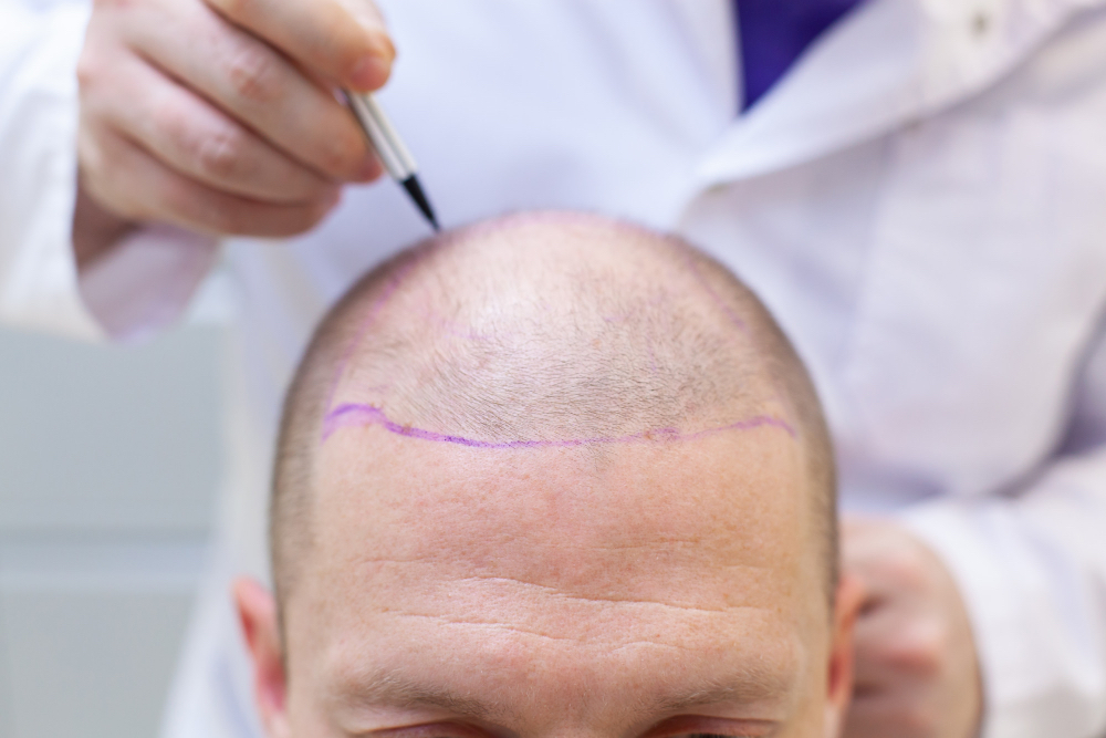 Najnowsze technologie i metody w przeszczepie włosów: Skokowe postępy w minimalizowaniu ryzyka i zwiększaniu skuteczności